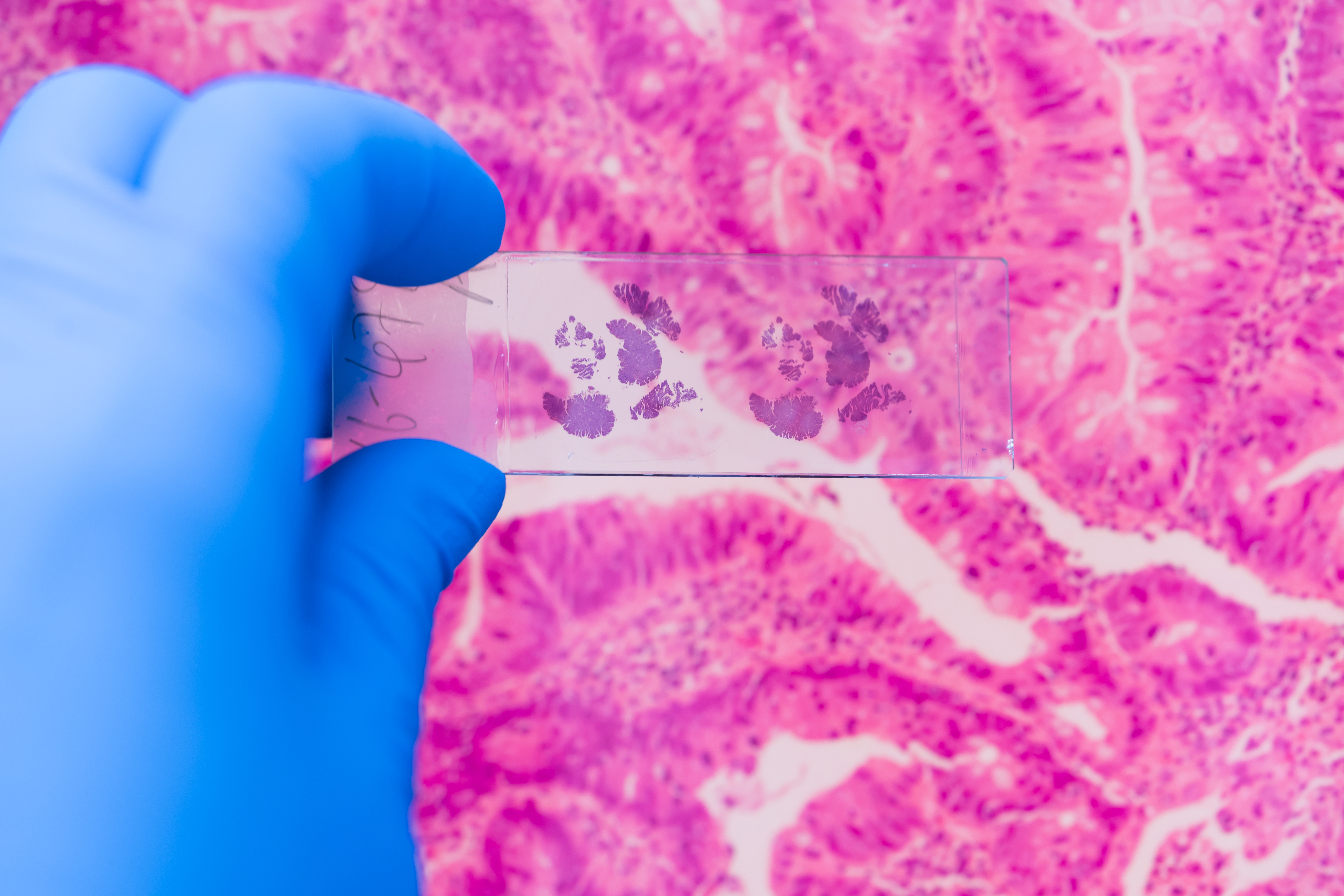 Breast Cancer Research V2
